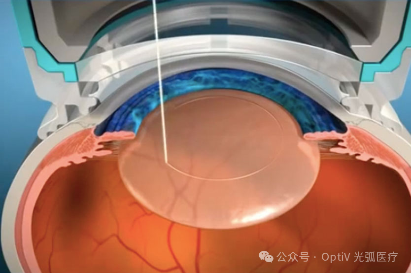 Femtosecond-Laser-Cataract-Surgery-Procedure-and-Benefits.jpg